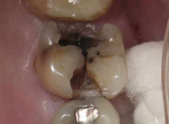 Cracked tooth repair cost